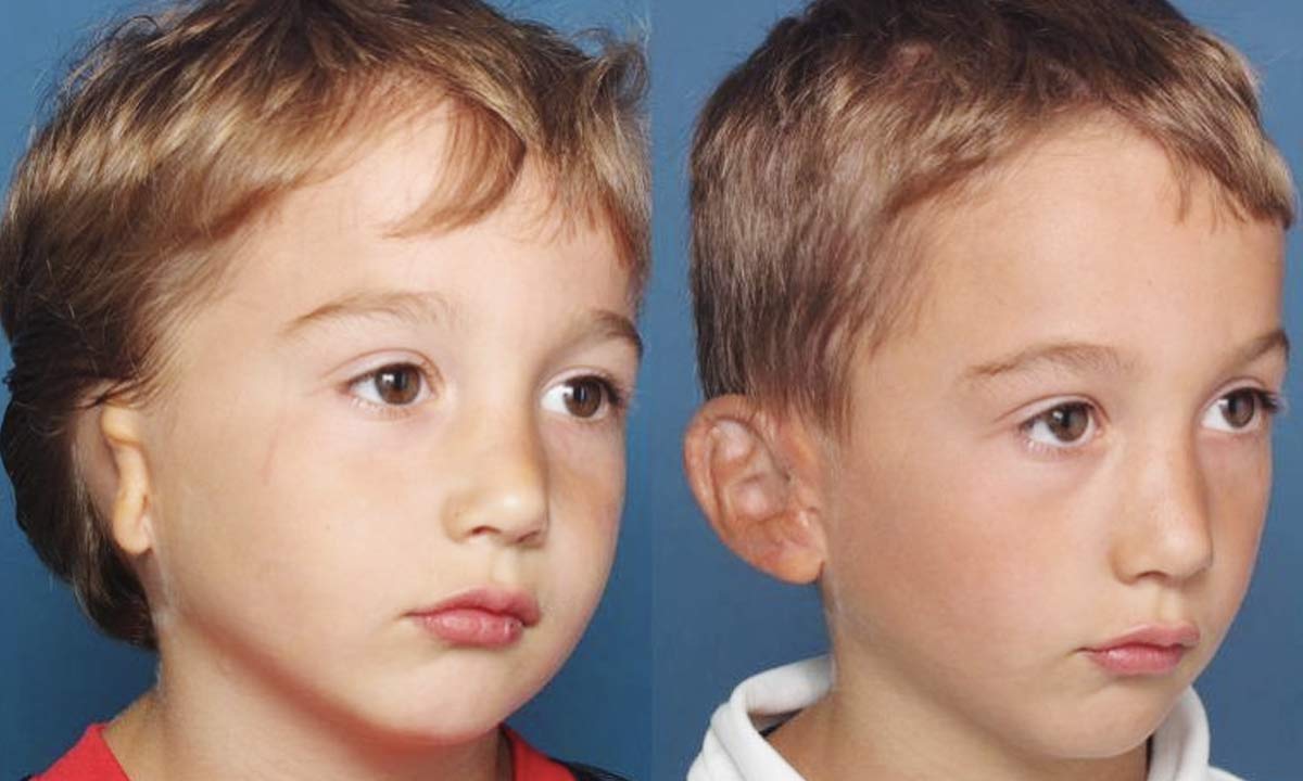 Anotia pada Bayi