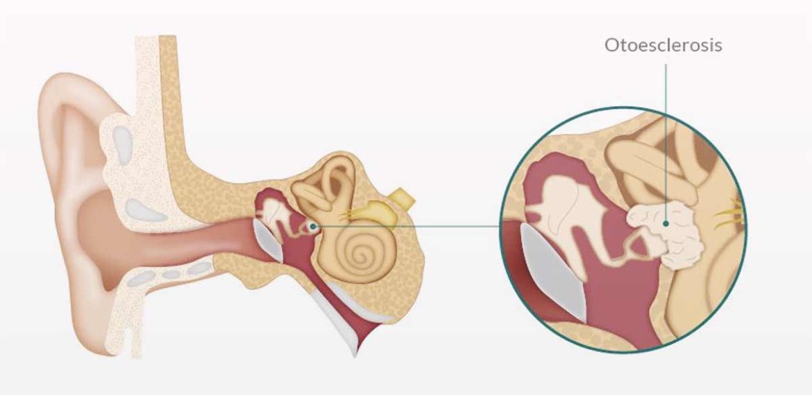 Otosklerosis