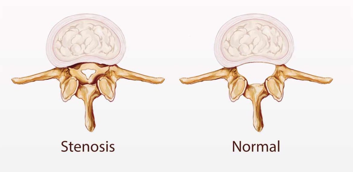 Stenosis Saluran Telinga