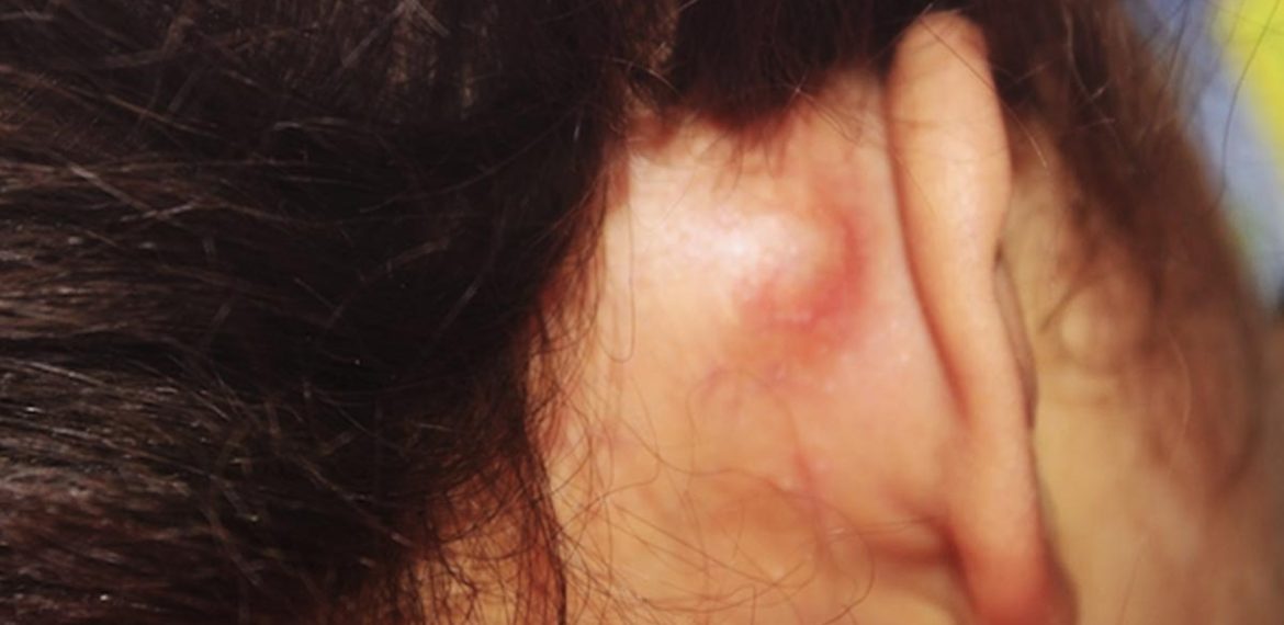 Mastoiditis
