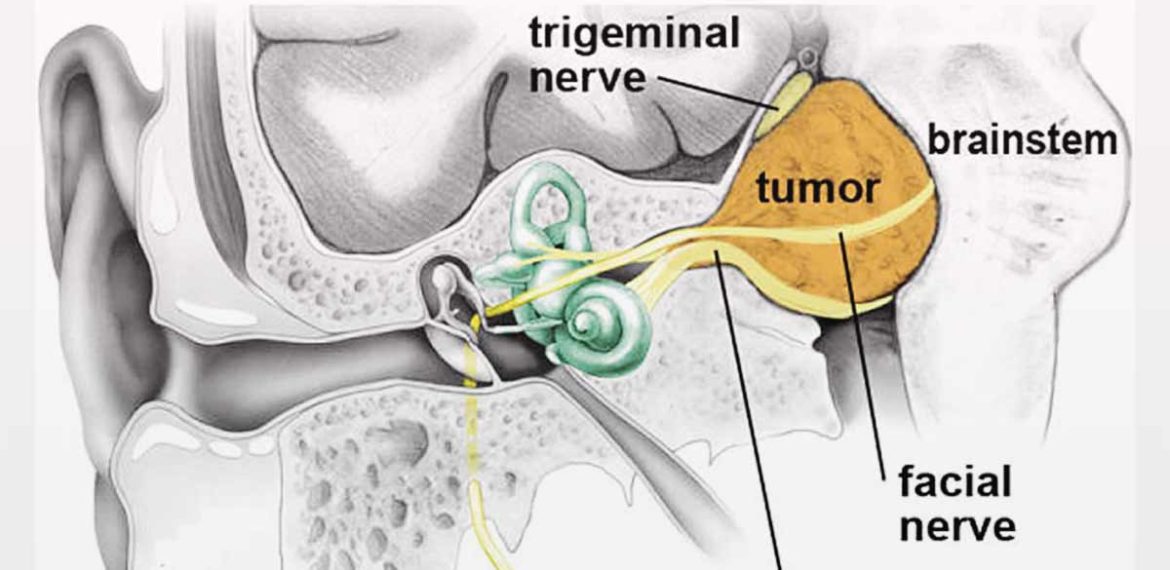 Schwannoma Vestibular