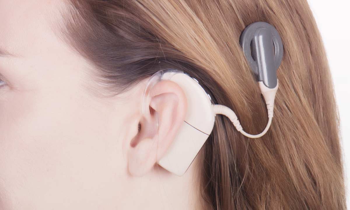 Manfaat Cochlear Implant