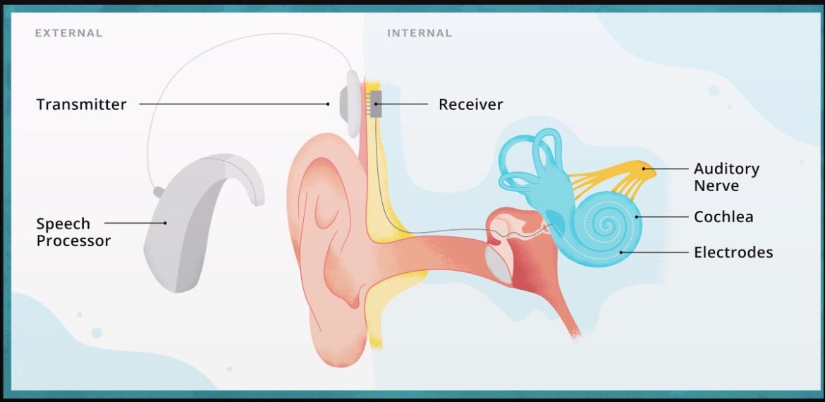 Komponen Cochlear Implant