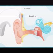 Komponen Cochlear Implant