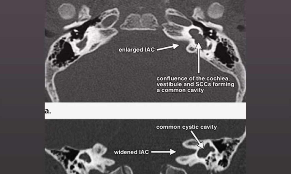 Dampak Enlarged Vestibular Aqueducts terhadap Pendengaran