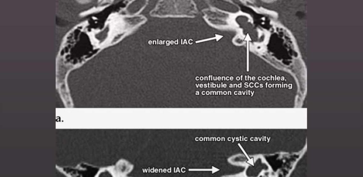 Enlarged Vestibular Aqueducts