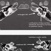 Enlarged Vestibular Aqueducts