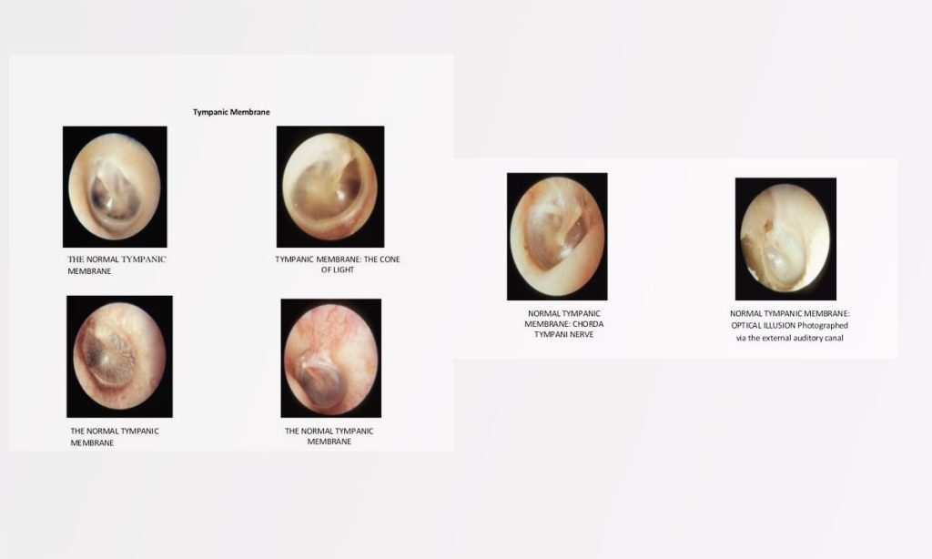 Gendang Telinga Pecah, Kondisi ketika Membran Timpani Robek