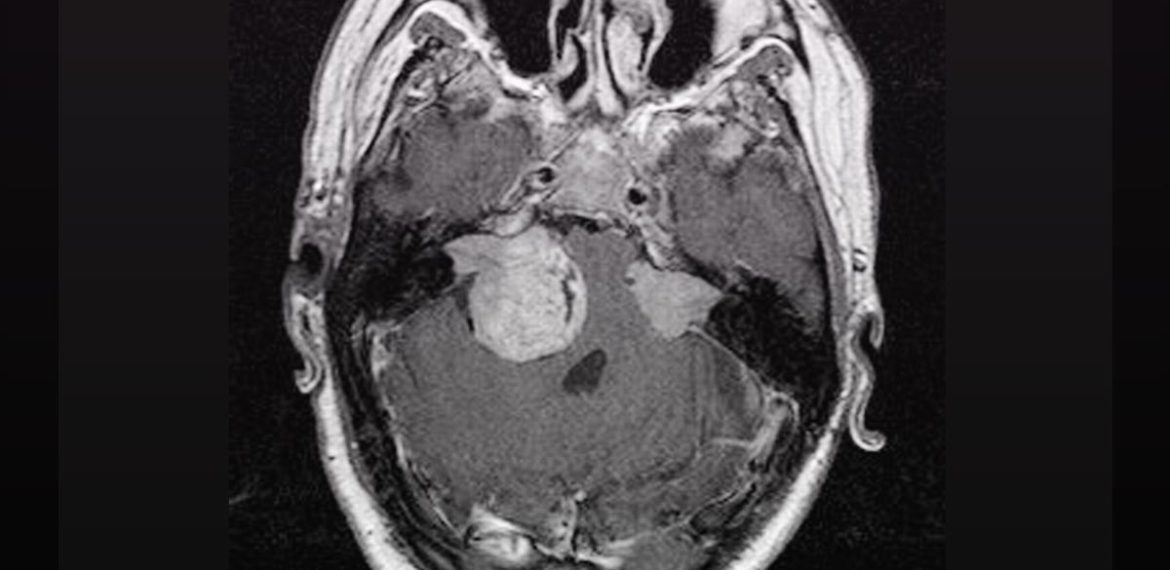 Perbedaan Schwannoma Vestibular Unilateral dan Bilateral
