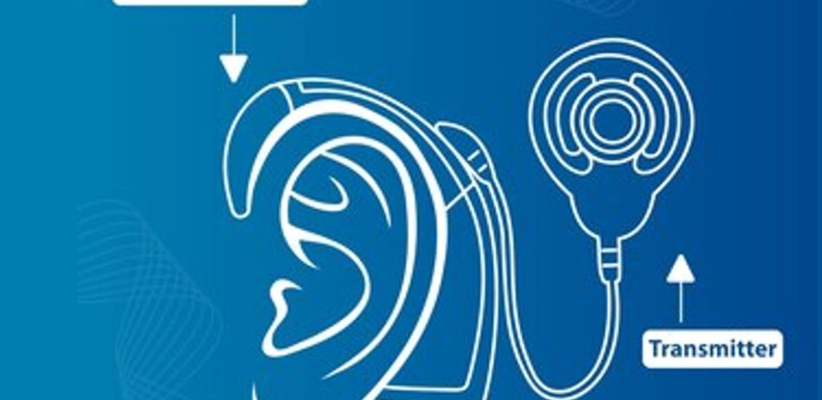 Cochlear Implant Lifespan