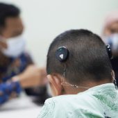 Pentingnya Mapping Rutin untuk Pengguna Cochlear Implant