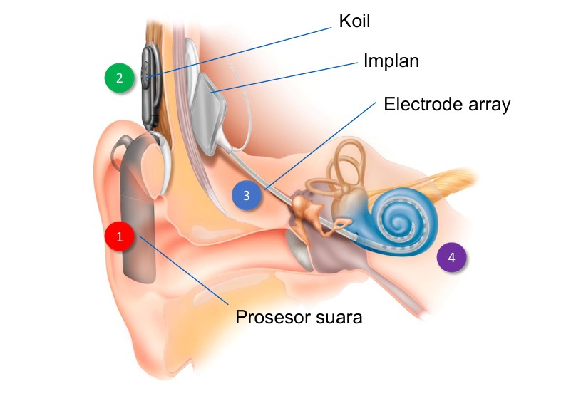 ilustrasi cara kerja alat Cochlear