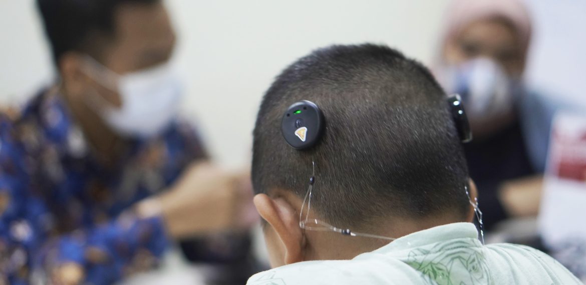 Ketahui apa itu implan koklea anak, biaya operasi, harga alat bantu dengar, hingga pusat alat bantu dengar terbaik di Indonesia. Solusi pendengaran terpercaya.