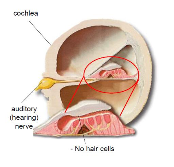 Koklea Abnormal (Tidak Normal)