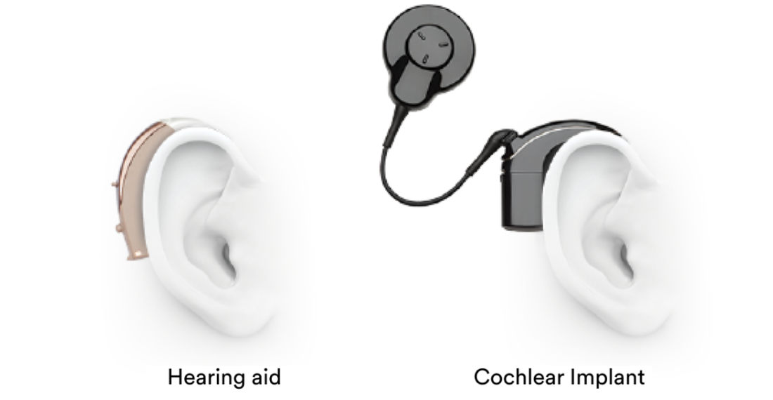 Kisaran Harga Cochlear Implant di Indonesia