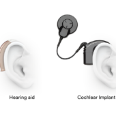 Kisaran Harga Cochlear Implant di Indonesia