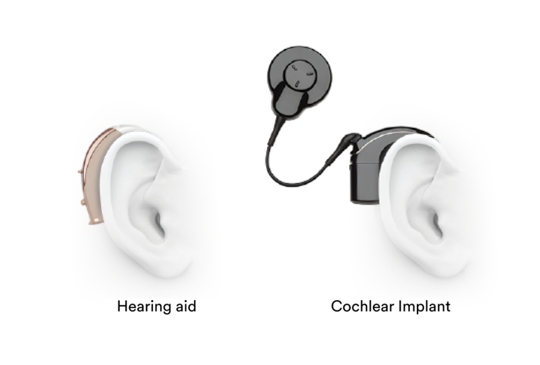 Kisaran Harga Cochlear Implant di Indonesia