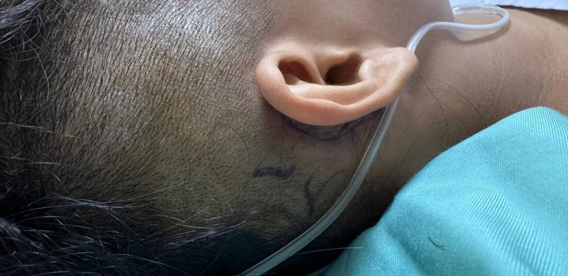 Cochlear Implant Teknologi SmartNav