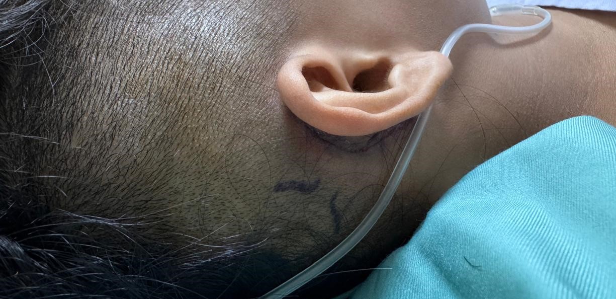 Cochlear Implant Teknologi SmartNav